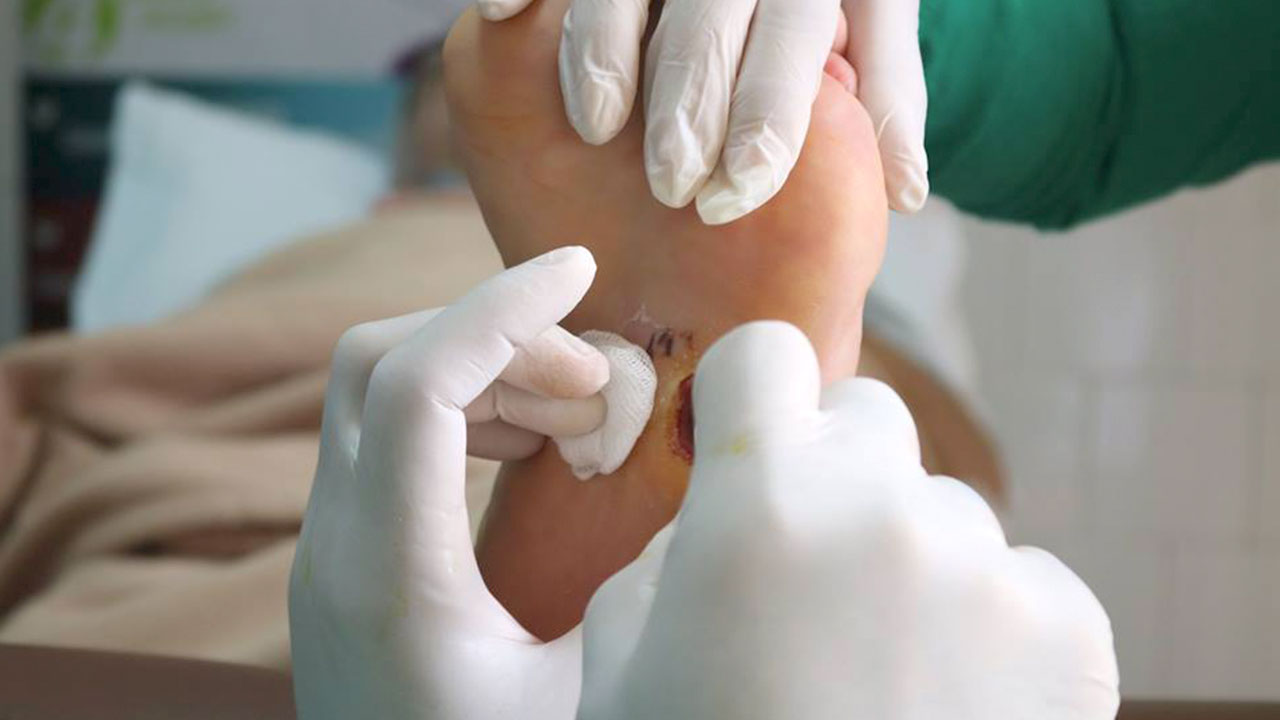 Con pasos seguros el pie diabético en Venezuela. Diario Octubre