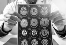 Científicos rusos desarrollan test para la detección temprana del alzhéimer